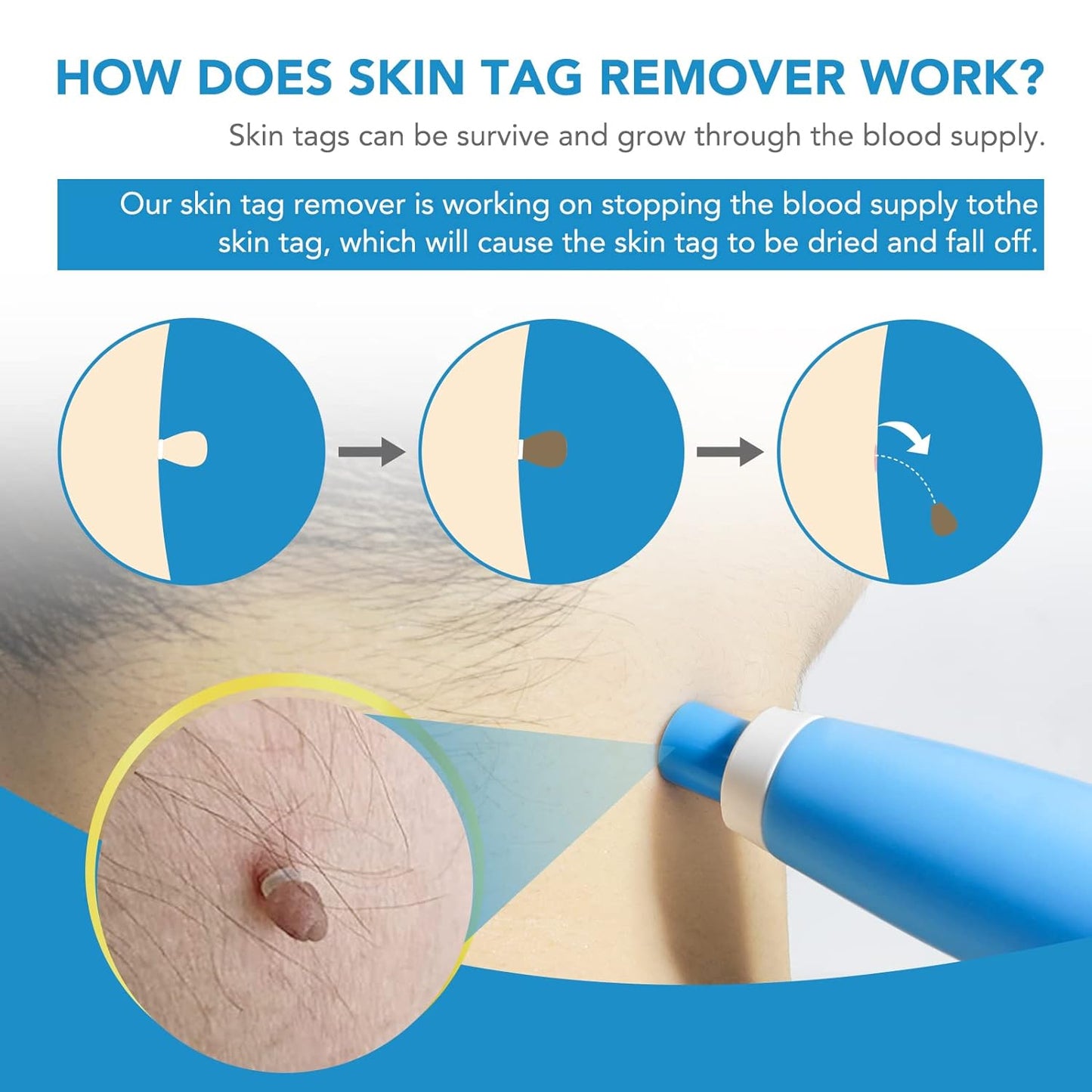 Skin Tag Remover Kit 2-in-1 for Micro to Large Warts (2 mm - 8 mm)