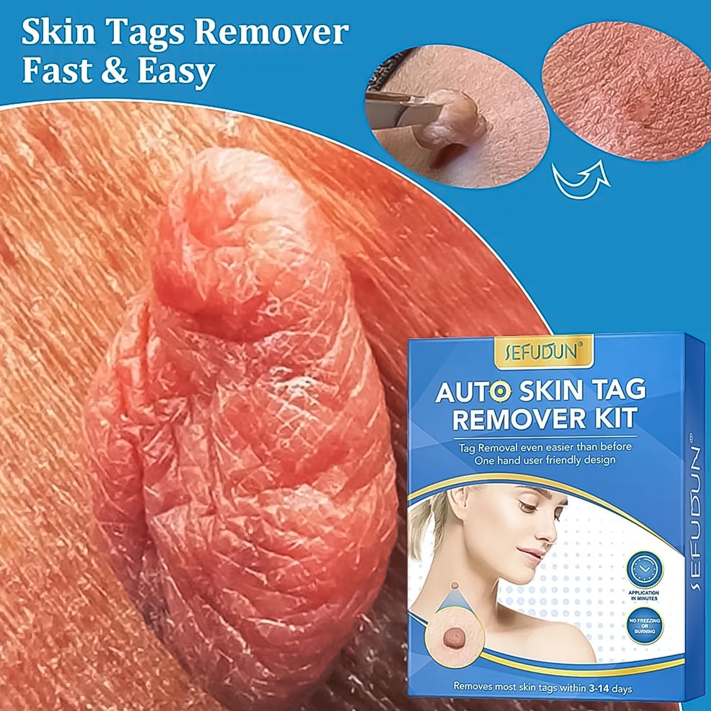 Skin Tag Remover Kit 2-in-1 for Micro to Large Warts (2 mm - 8 mm)