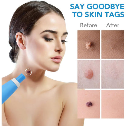 Skin Tag Remover Kit 2-in-1 for Micro to Large Warts (2 mm - 8 mm)